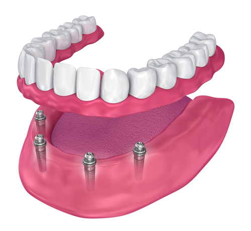 can-dentures-be-stabilized-with-dental-implants
