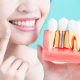how-dental-implants-can-help-retain-dentures