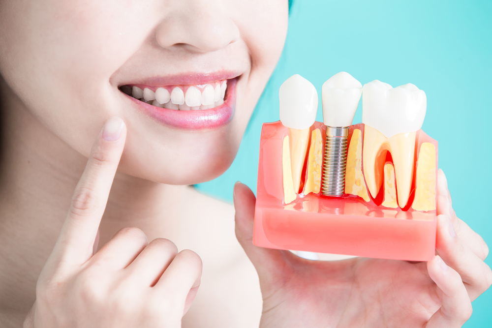 how-dental-implants-can-help-retain-dentures
