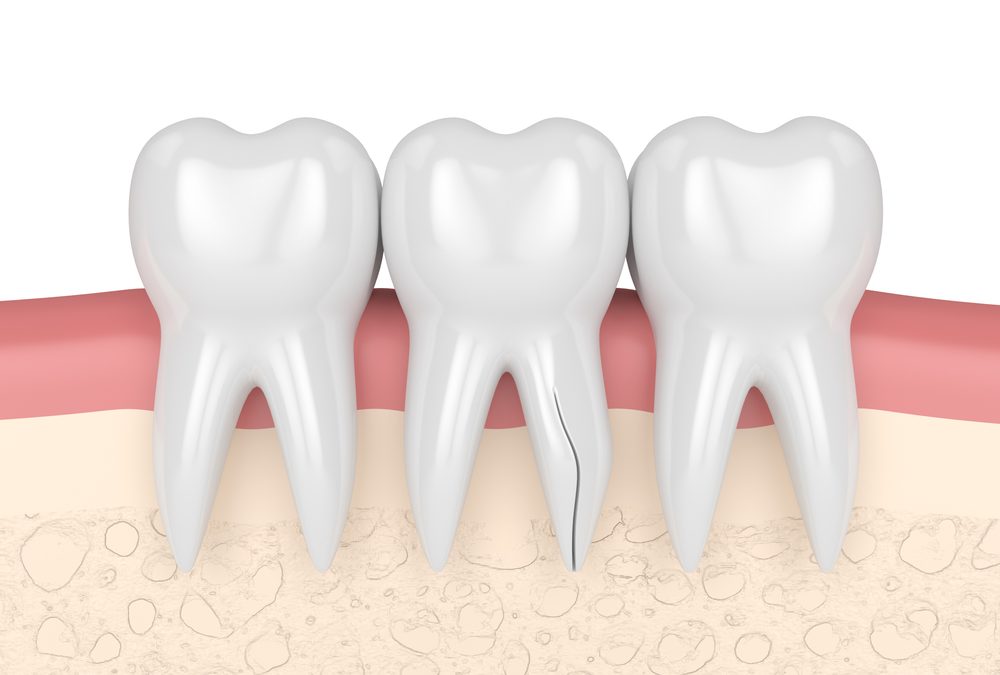 Categorization of Dental Fractures